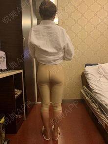 大腿吸脂视频,见证身材蜕变奇迹