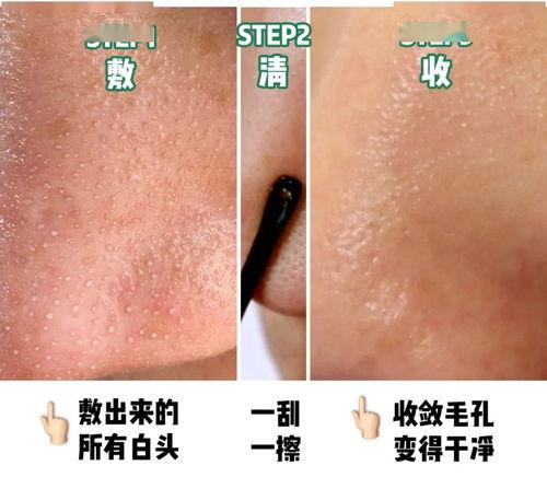 黑头贴视频,效果惊人揭秘！