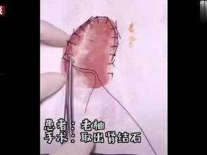 开刀手术视频,开刀手术全过程深度解析