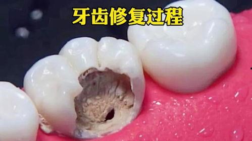 修蛀牙视频,从诊断到治疗，一图看懂