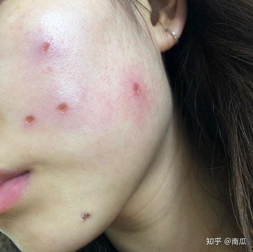 激光祛痣视频,高效便捷的美容新选择