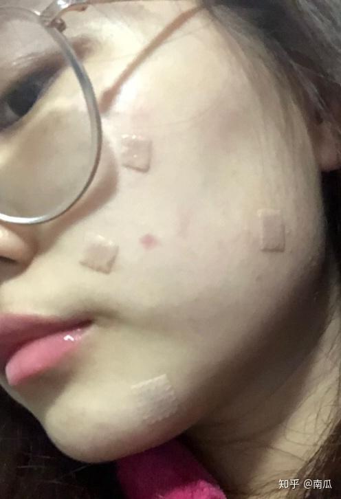 激光祛痣视频,高效便捷的美容新选择