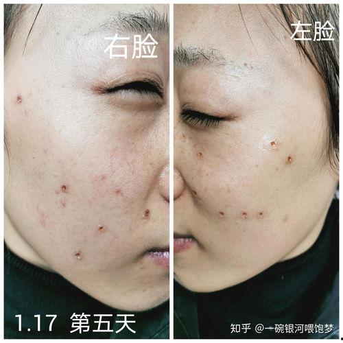 激光祛痣视频,高效便捷的美容新选择