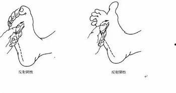 跟腱反射检查方法视频,跟腱反射检查方法视频详解