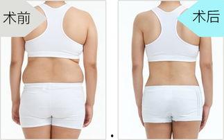 大腿抽脂视频,见证身材重塑奇迹