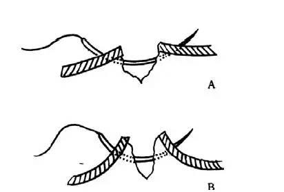 伤口缝合视频,视频教学带你轻松掌握