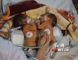 连体婴儿视频,生命相连，共度时光
