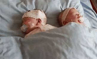 连体婴儿视频,生命相连，共度时光